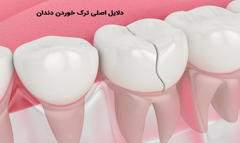 5 دلیل اصلی ترک خوردن دندان‌ها